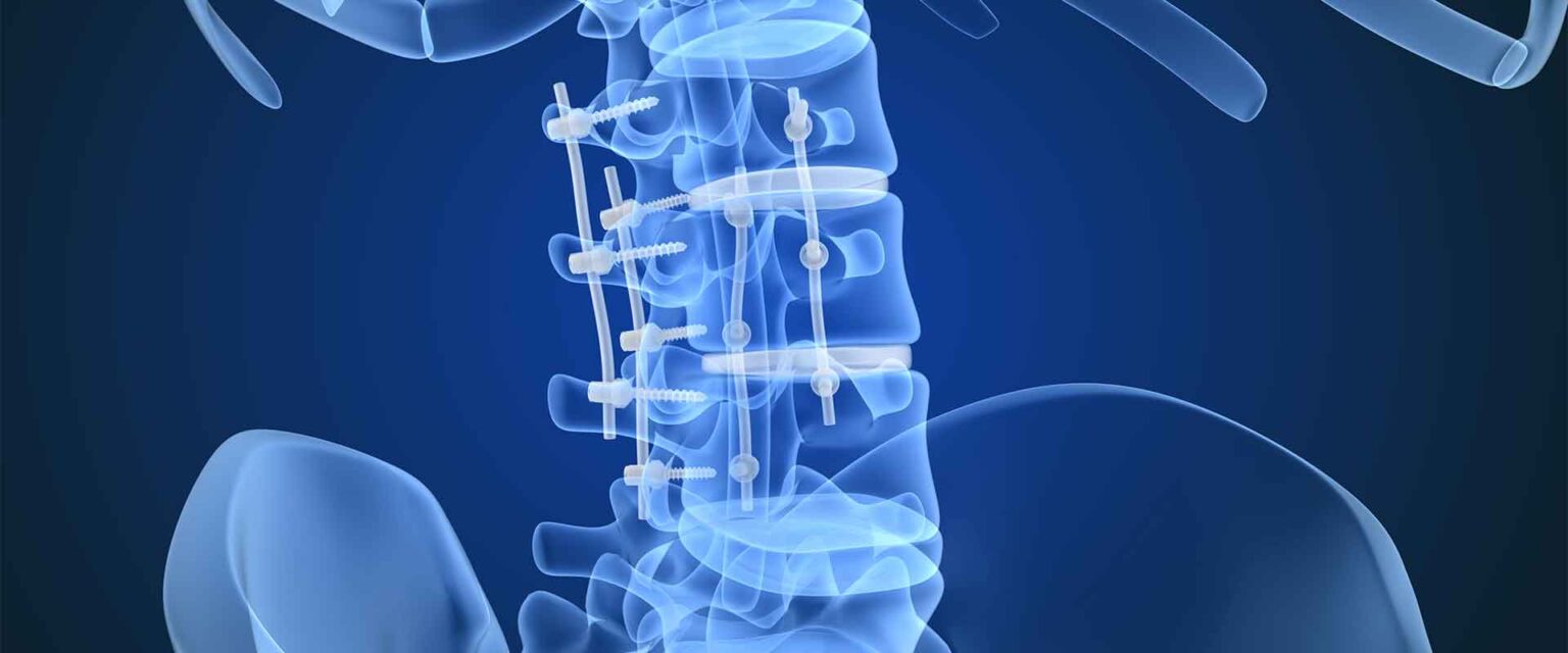 Spinal Implants And Peek Device Applications Genesis Medical Plastics